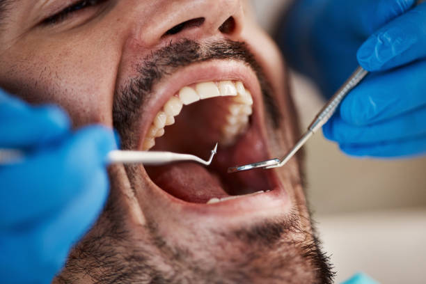Best Emergency Dental Extractions in Beverly Hills, TX