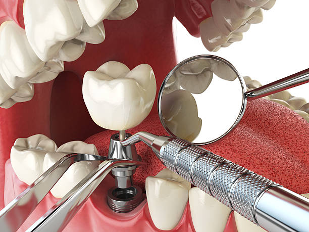 Best Emergency Dentist for Lost Fillings or Crowns in Beverly Hills, TX
